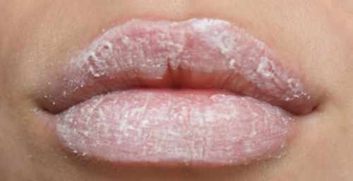 Сухость губ причины какой болезни, трещины. Лечение, средства, как избавиться