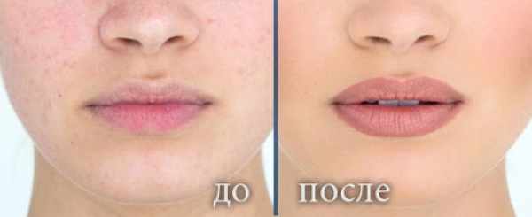 Гранулы Фордайса и перманентный макияж губ. Фото до и после, отзывы
