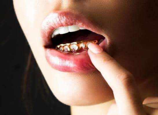 Грилзы на зубы. Что это такое, золотые, серебряные, с бриллиантами, белые. Цена