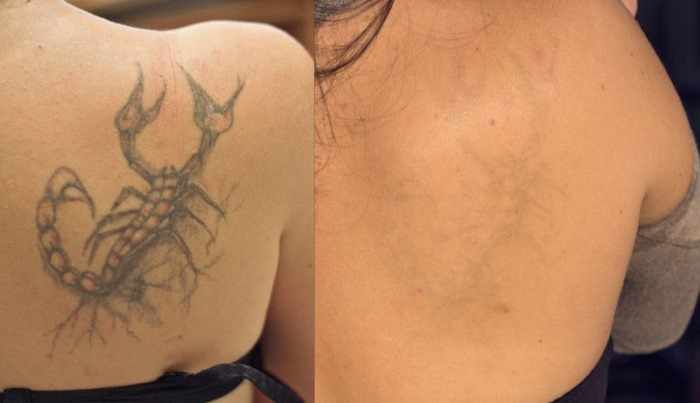 Как вывести татуировку лазером, рецепты в домашних условиях без шрамов. Фото до и после