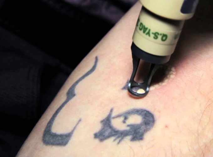Как вывести татуировку лазером, рецепты в домашних условиях без шрамов. Фото до и после